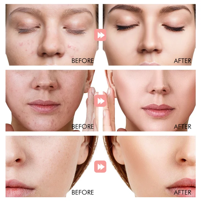 Biosphere 4 in 1 Brighten Skin Care Set, Moisturizer Acne Care of sensitive Skin